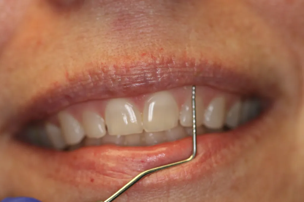 Gummy Smile After