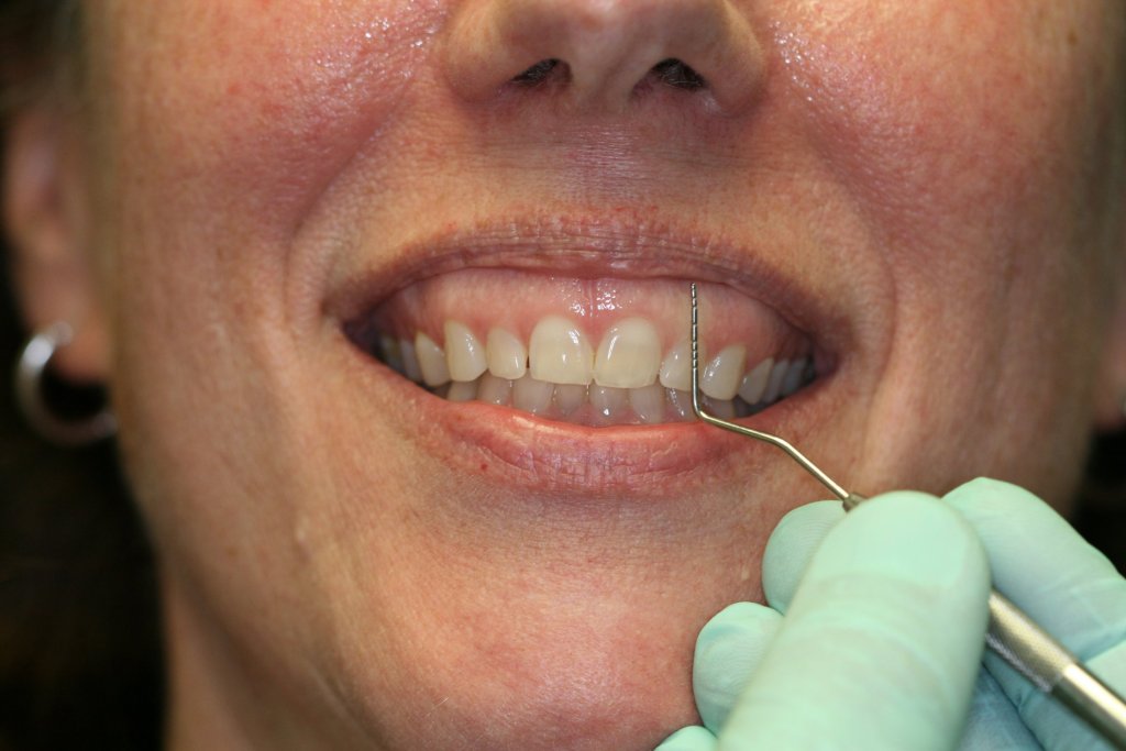 Gummy Smile Before