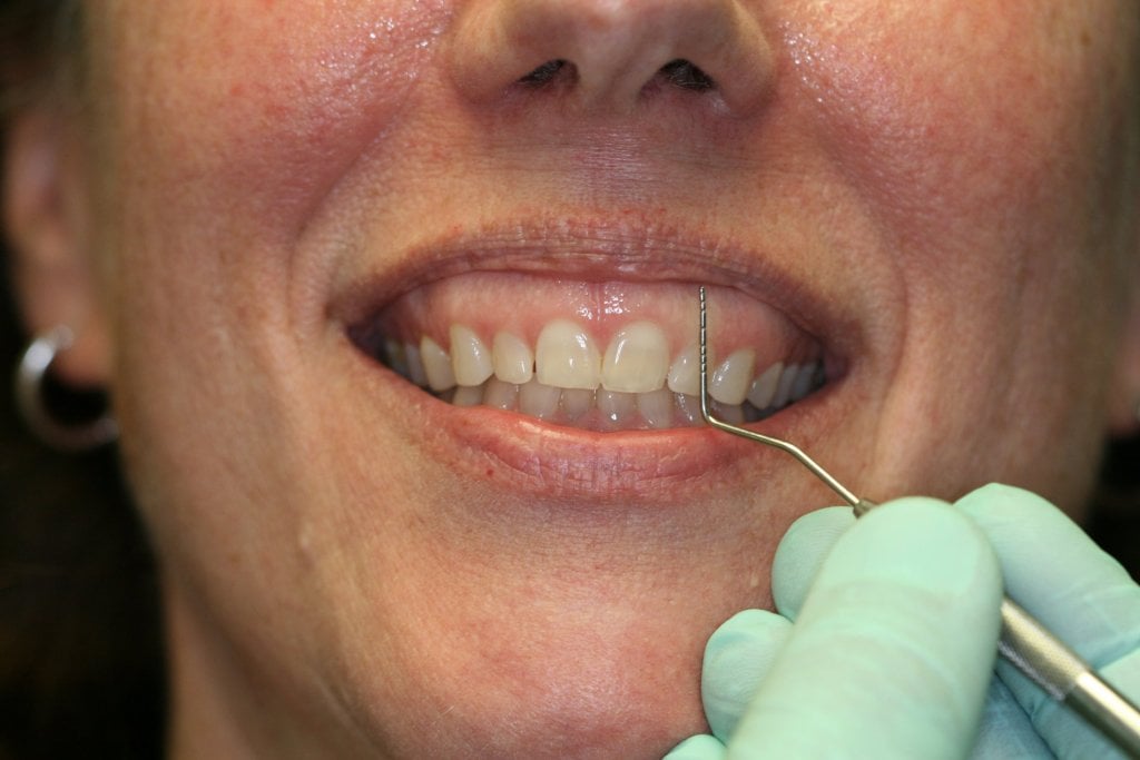 Gummy Smile Before