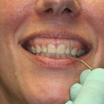 Gummy Smile Before